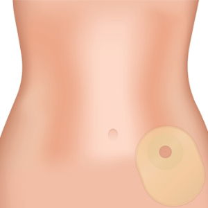 Ostomy